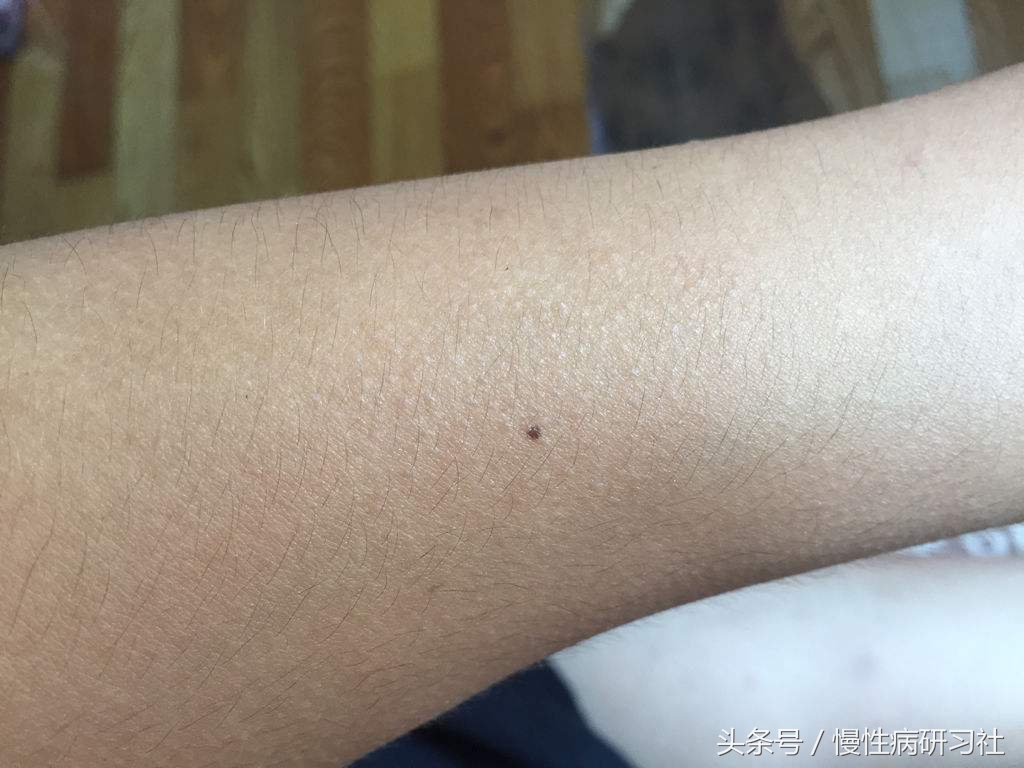 一个老人因信网上偏方治病致死,山东民间中医高手治皮肤病