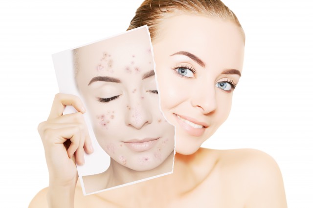 珍珠粉祛痘印的用法,珍珠粉加什么可以祛除痘印