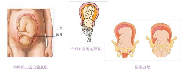 女性盆底健康的意义,盆底肌对女性有什么作用