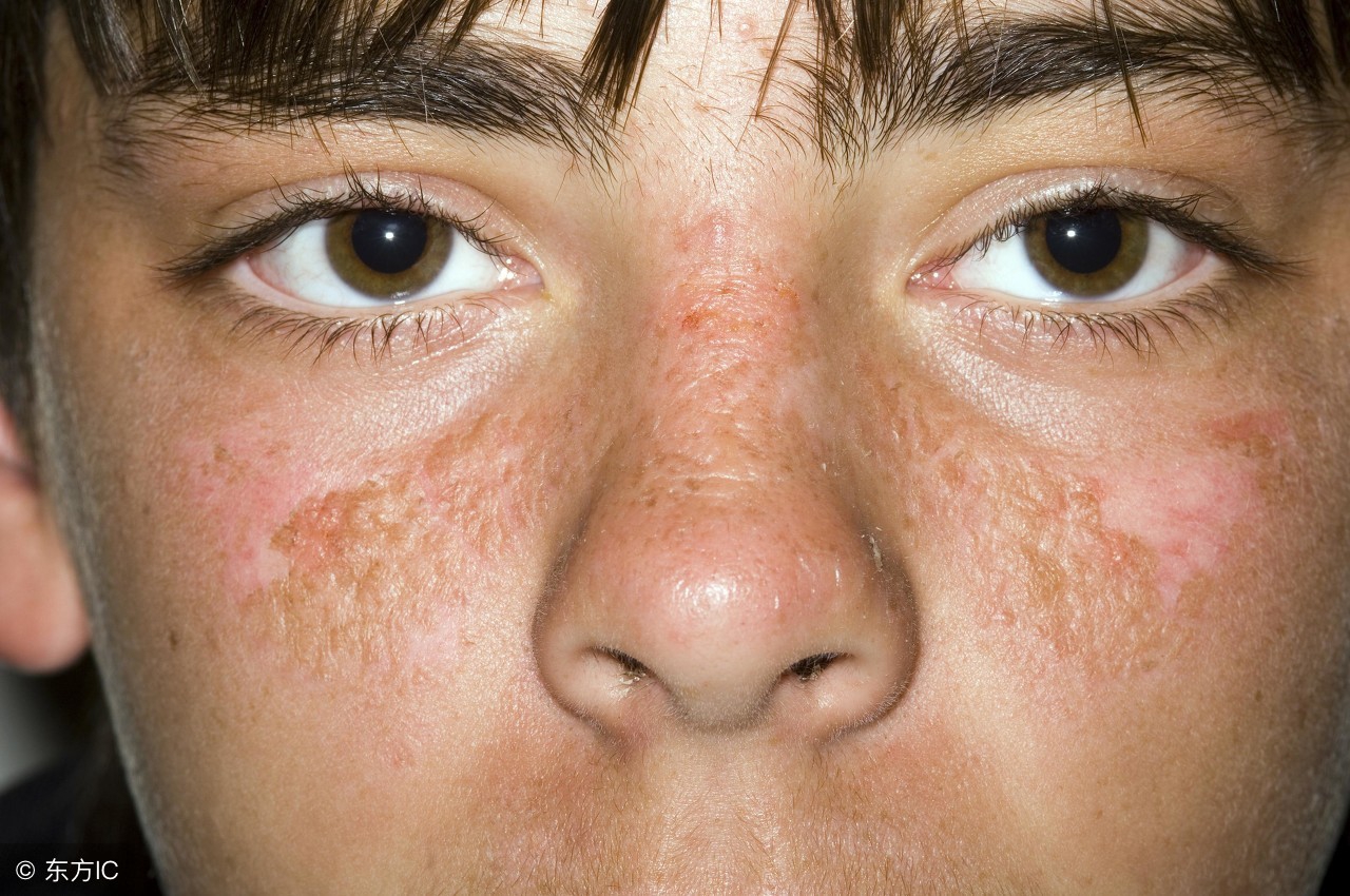 怎样防晒斑,晒斑为什么说永远不可能去除