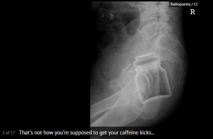 盘点X光透视下的人体异物，看着都痛！