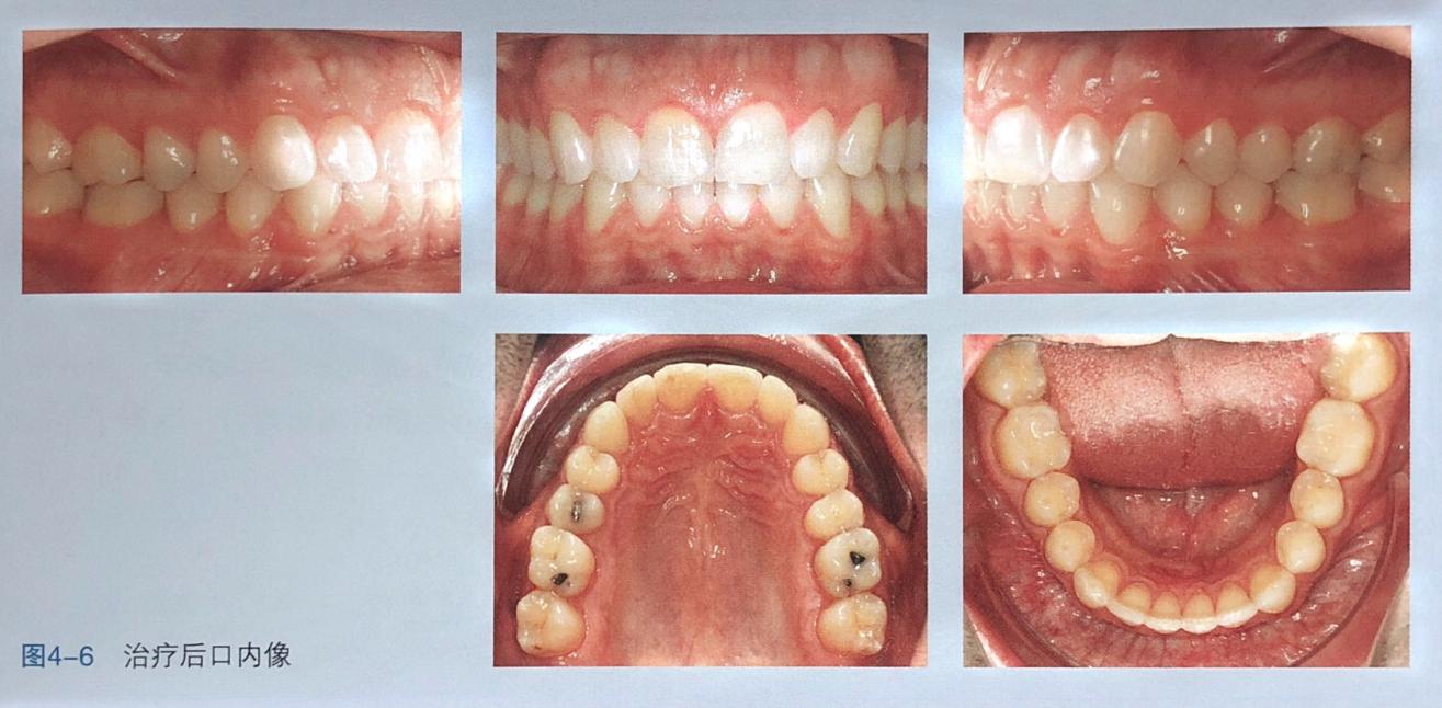 牙齿上的黑三角怎么回事,牙齿上的黑三角怎么改善
