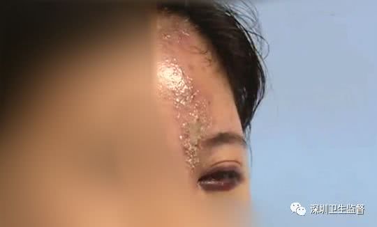 90后女子注射6针玻尿酸致残,女大学生打玻尿酸