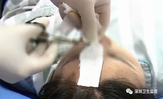 90后女子注射6针玻尿酸致残,女大学生打玻尿酸