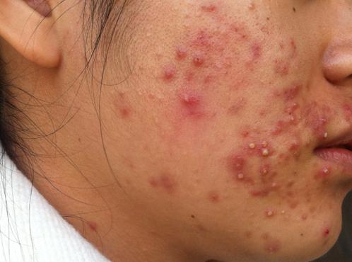 激素脸有多可怕,激素脸怎么办最快最有效的方法