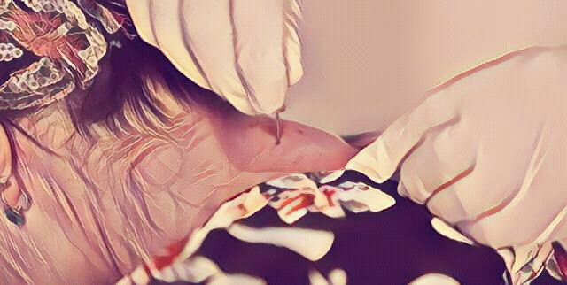 小针刀治疗交感型颈椎病,小针刀治疗颈椎病对手麻有效果吗