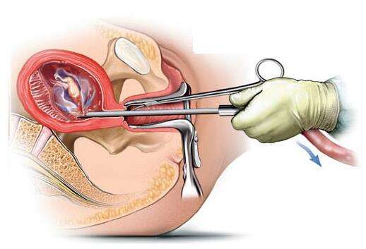 早期流产怎么调理身体,孕早期流产后注意事项和调理