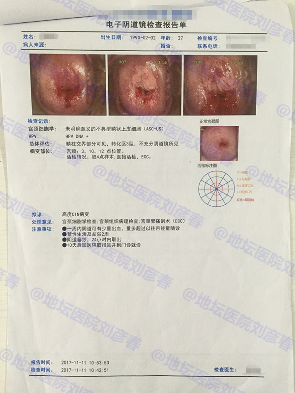 病例分享——27岁女性宫颈CIN3级病变并累及腺体，意味着什么？
