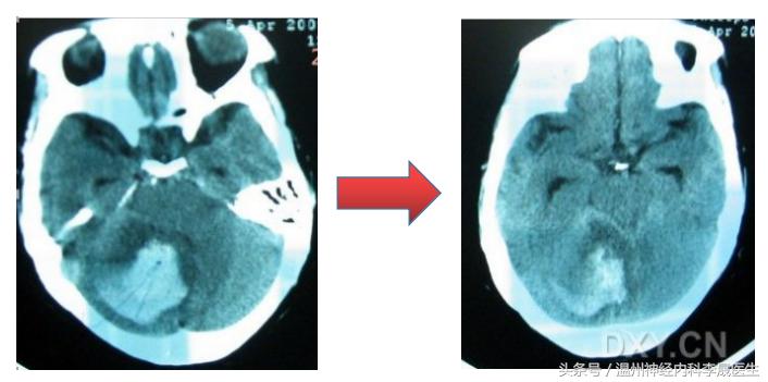 脑出血后遗症患者李医生,中风脑出血最有效的治疗方案