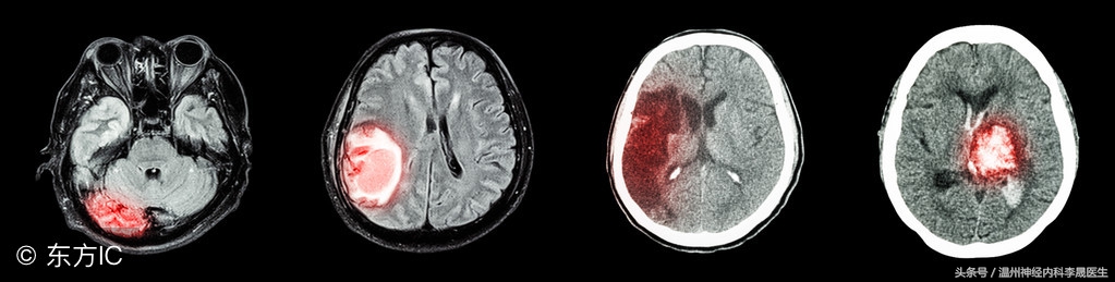 脑出血后遗症患者李医生,中风脑出血最有效的治疗方案