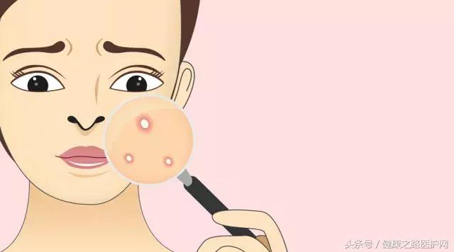 拔黑头粉刺过程细节,挤痘痘和拔黑头手法
