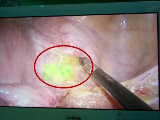 荧光肿瘤检测准确率高吗,荧光造影用什么药物