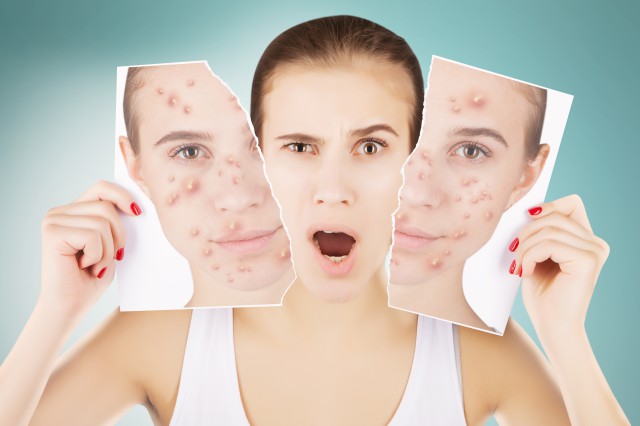 珍珠粉祛痘印的用法,珍珠粉加什么可以祛除痘印