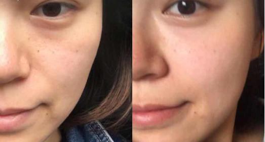 爱笑的女生如何避免法令纹加深,消除笑出来的法令纹最佳方法