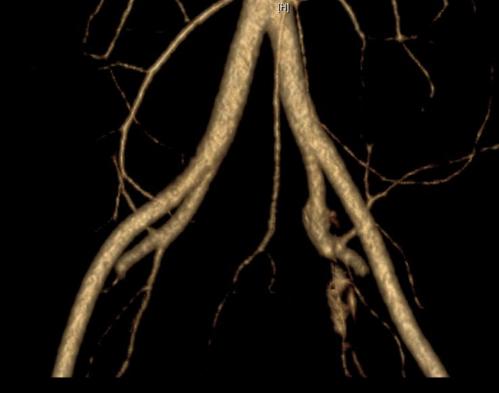 年纪轻轻怎么会一条腿反复血栓,年龄大了得了腿血栓怎么办