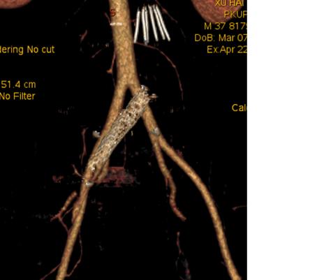 年纪轻轻怎么会一条腿反复血栓,年龄大了得了腿血栓怎么办