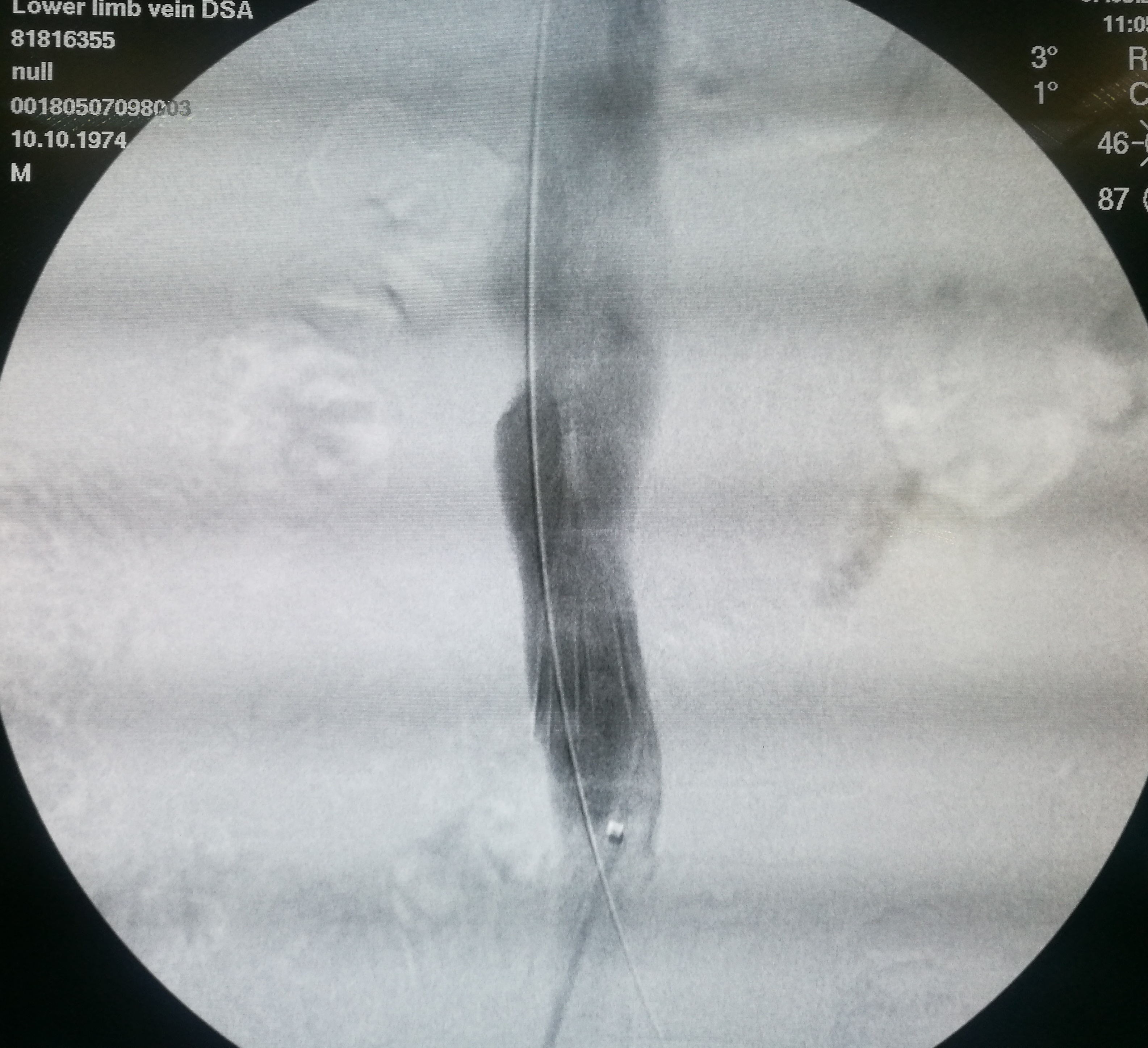 年纪轻轻怎么会一条腿反复血栓,年龄大了得了腿血栓怎么办