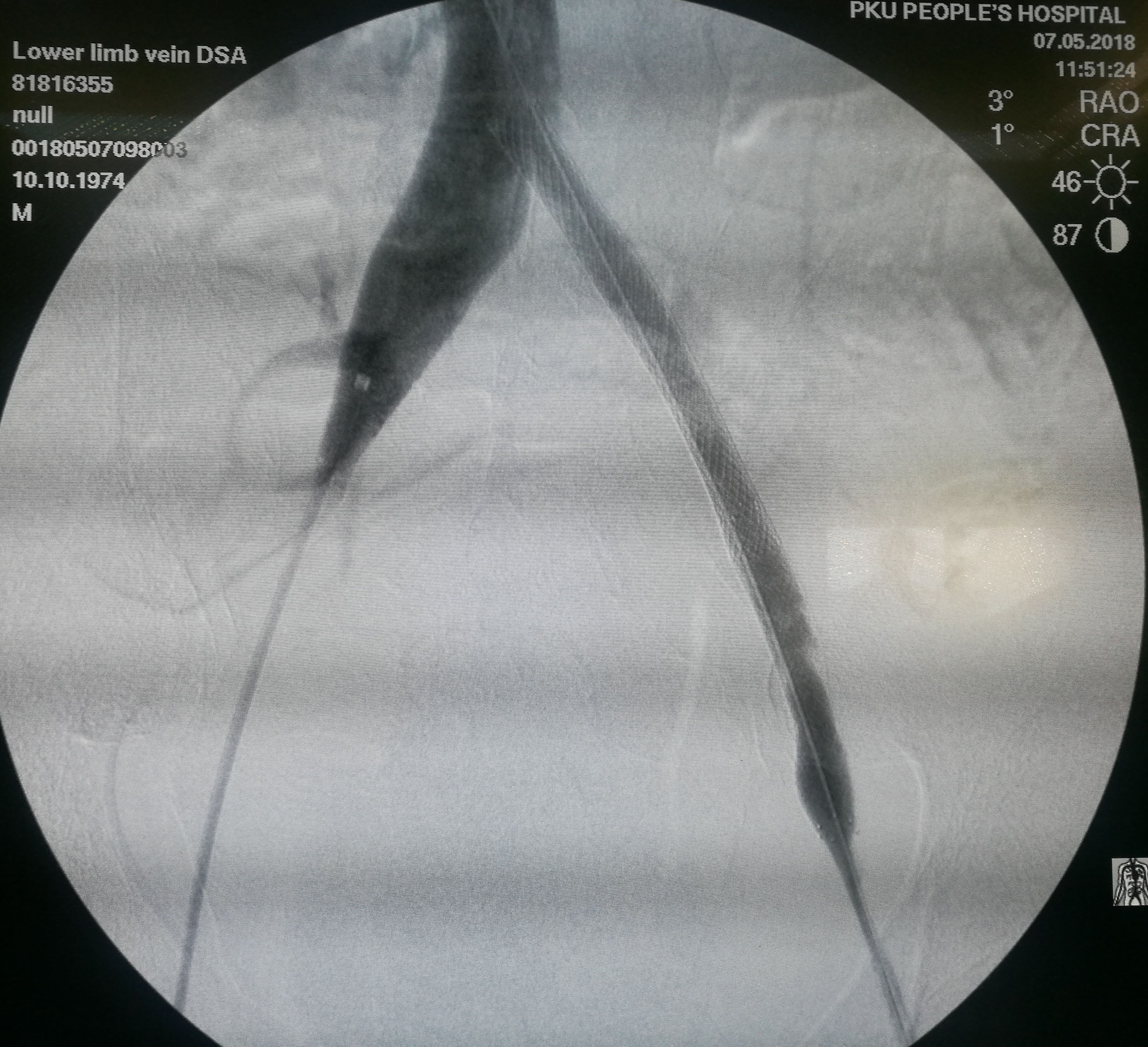 年纪轻轻怎么会一条腿反复血栓,年龄大了得了腿血栓怎么办