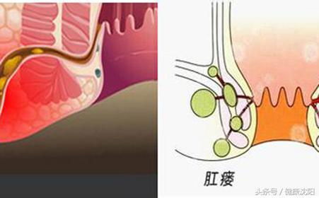 健康科普堂|还你一个整洁的PP——肛瘘的防与治