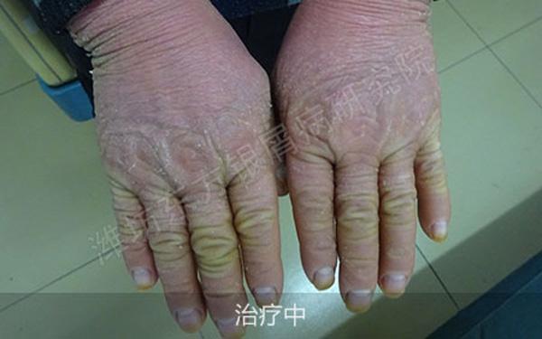 关节型牛皮癣用什么药,牛皮癣的种类和特征