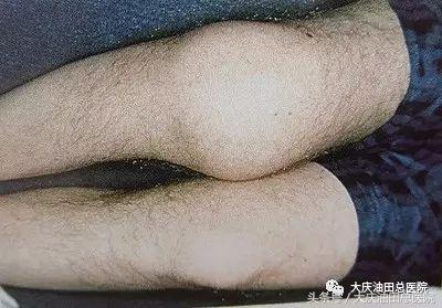 厉害了!“玻璃人”在总院获救