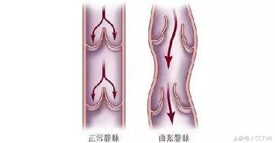 蚯蚓纹是怎么回事呢,大腿根部蚯蚓纹越来越多