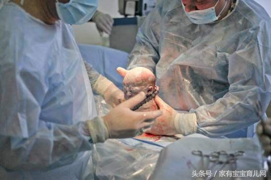 女人一生可以剖腹产几次最多,女人一生可以几次剖腹产