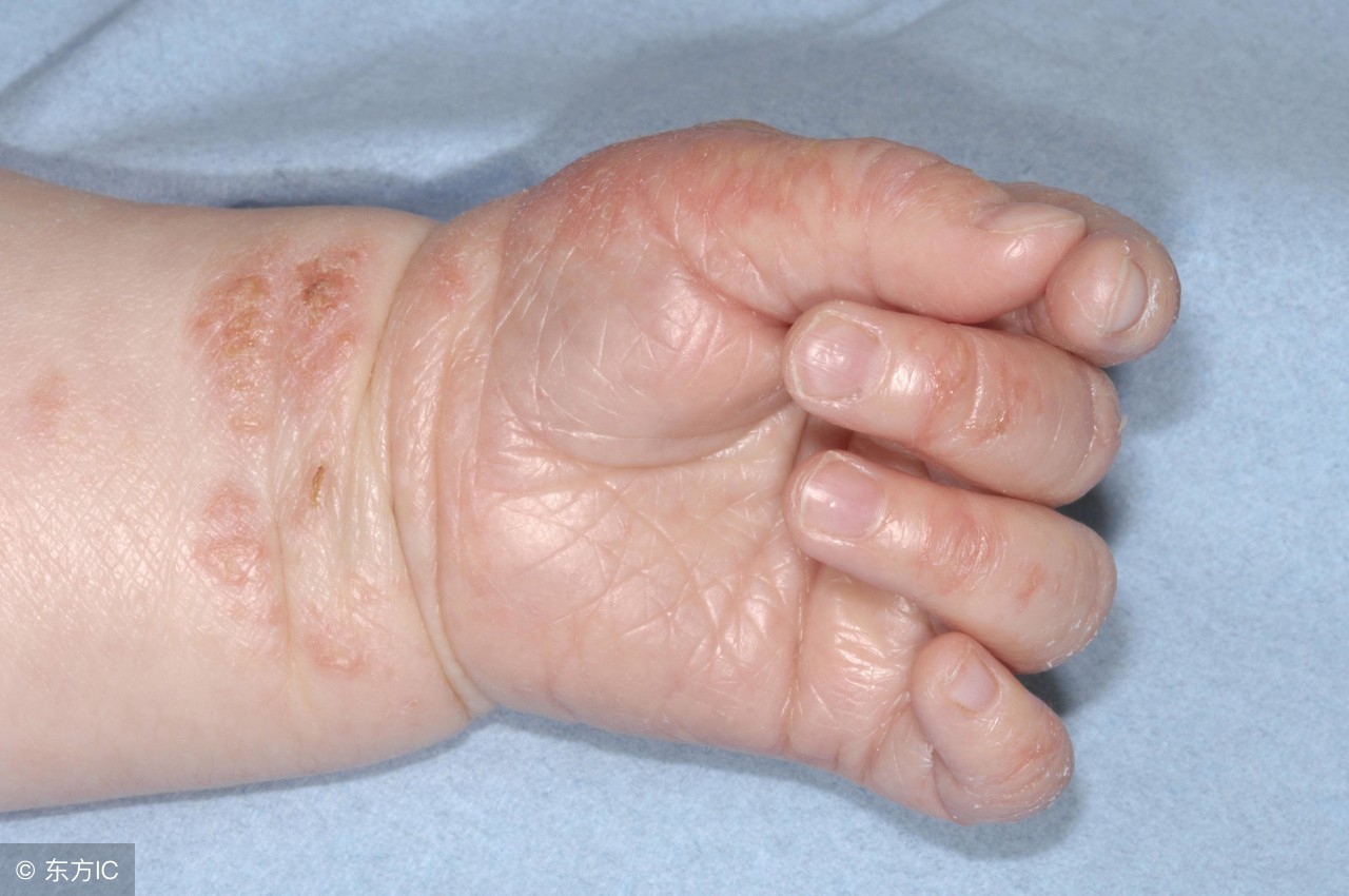 湿疹反复发作瘙痒难忍,肛周瘙痒湿疹反复发作