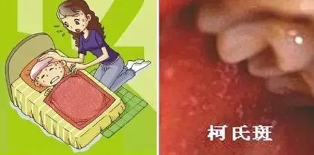 荨麻疹,麻疹应该怎么治疗好一点