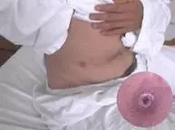 什么样的毒虫咬会起大水泡,夏天3种虫咬可致命