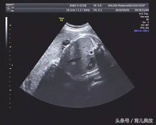 胎儿b超未见胆囊怎么进一步确诊,孕28周胎儿心脏彩超没做