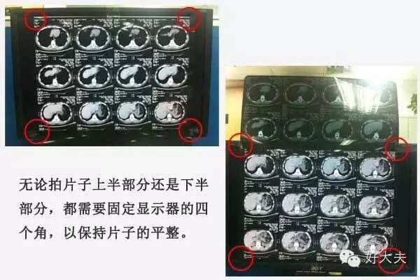 家里怎么拍片子给医生,如何把拍的ct片发给医生