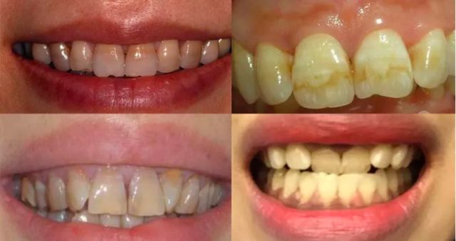 漱口水洁牙慕斯,比牙膏好用的漱口水