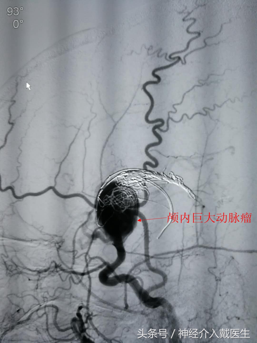 动脉瘤诊断与鉴别诊断,脑动脉瘤出血100ml手术预后