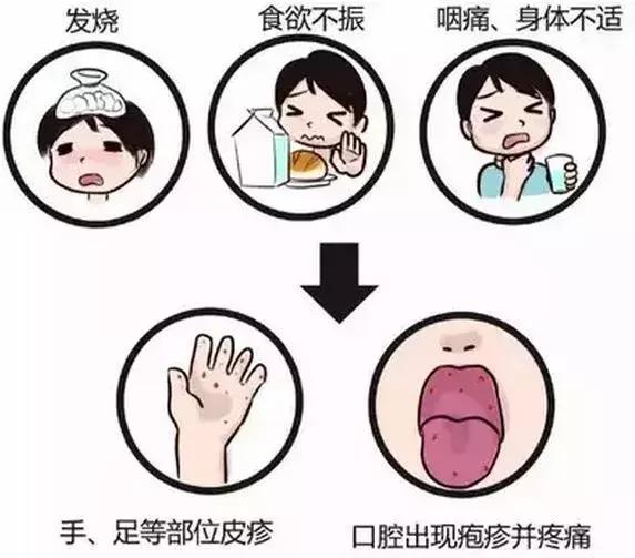 手足口刚发病是什么症状,手足口病怎么算发病时间