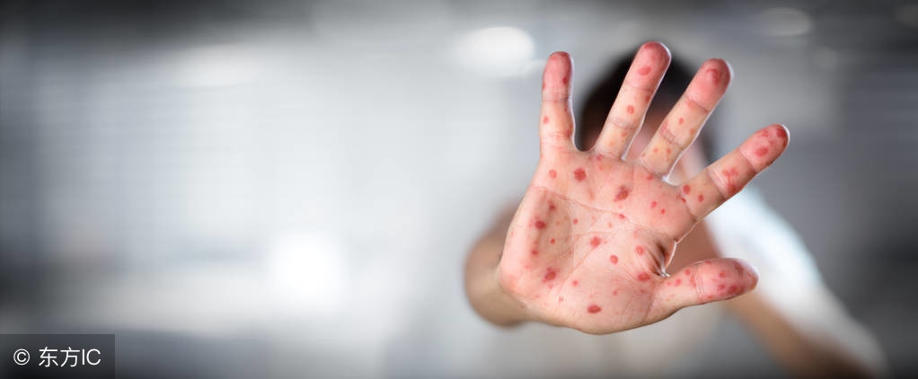 手足口刚发病是什么症状,手足口病怎么算发病时间