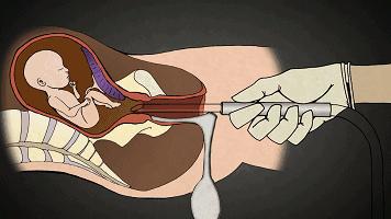 为什么一定要戴套？！情人节就要到了，为了自己，大家都看看吧……