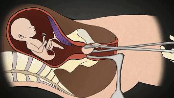 为什么一定要戴套?!情人节就要到了,为了自己,大家都看看吧……