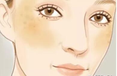 褐斑是什么原因形成的,褐斑是由什么导致的