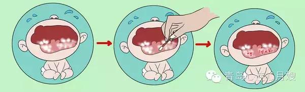 妈妈必知:学会轻松应对宝宝鹅口疮
