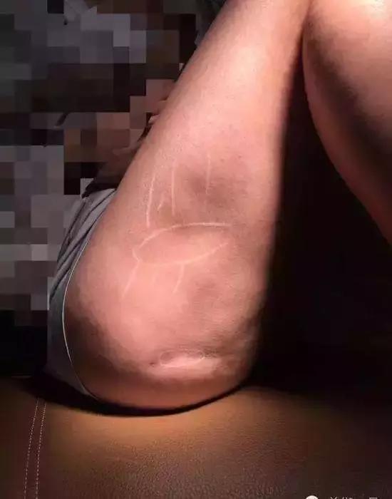 抽脂越来越多的女孩,抽脂的女人能要吗