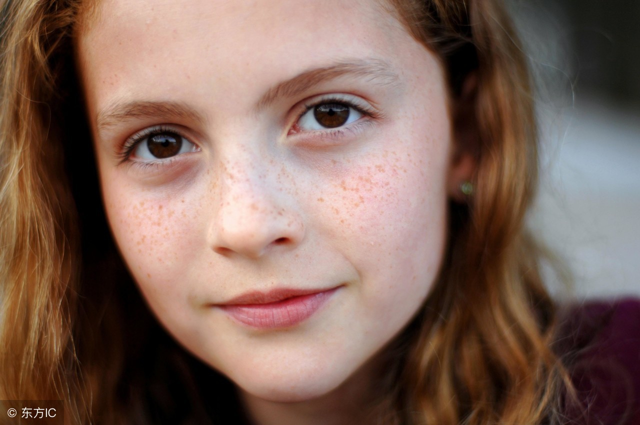 遗传性雀斑可以用去除雀斑产品吗,白人女孩的雀斑怎么去除