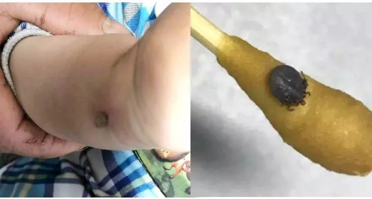 蜱虫常见的3个地方及解决技巧,蜱虫怎么预防出现在人身上