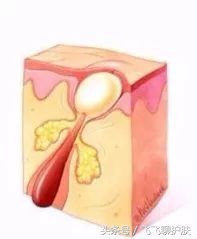 大概只有自己最清楚为什么长痘,各种痘痘类型都是如何产生的