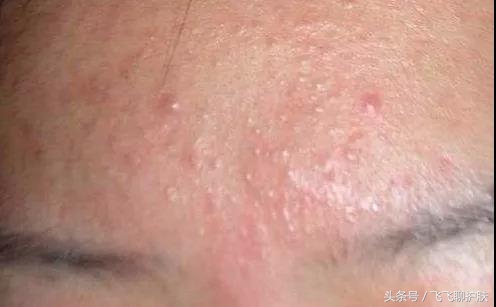 大概只有自己最清楚为什么长痘,各种痘痘类型都是如何产生的