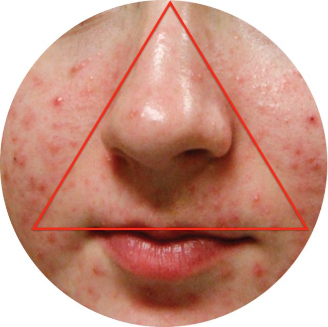 揭秘|掰着指头数数被痘痘骚扰了多少年?弘叔帮你终止在今年夏天!(上)