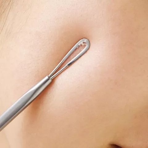 揭秘|掰着指头数数被痘痘骚扰了多少年?弘叔帮你终止在今年夏天!(上)