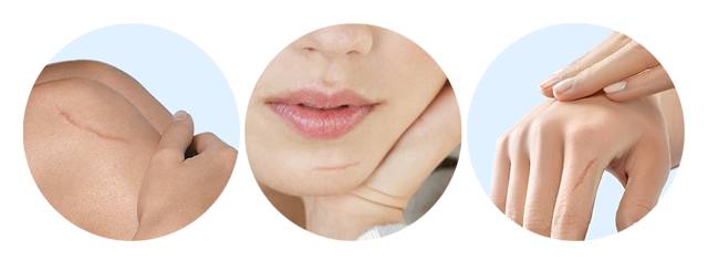 拼团｜抹了它，痘印、疤痕全都慢慢消失了