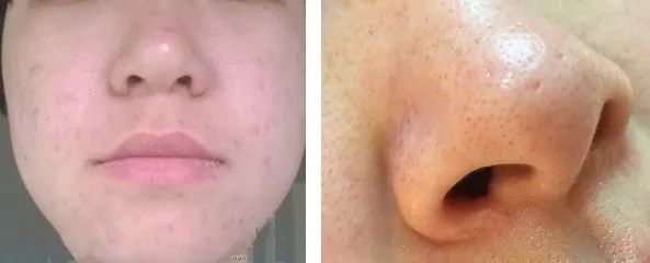 轻轻抹一抹皮肤越来越好,轻轻擦到皮肤就留下黑印子