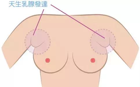 腋下难看的那两坨肉，可以转变为乳房吗？